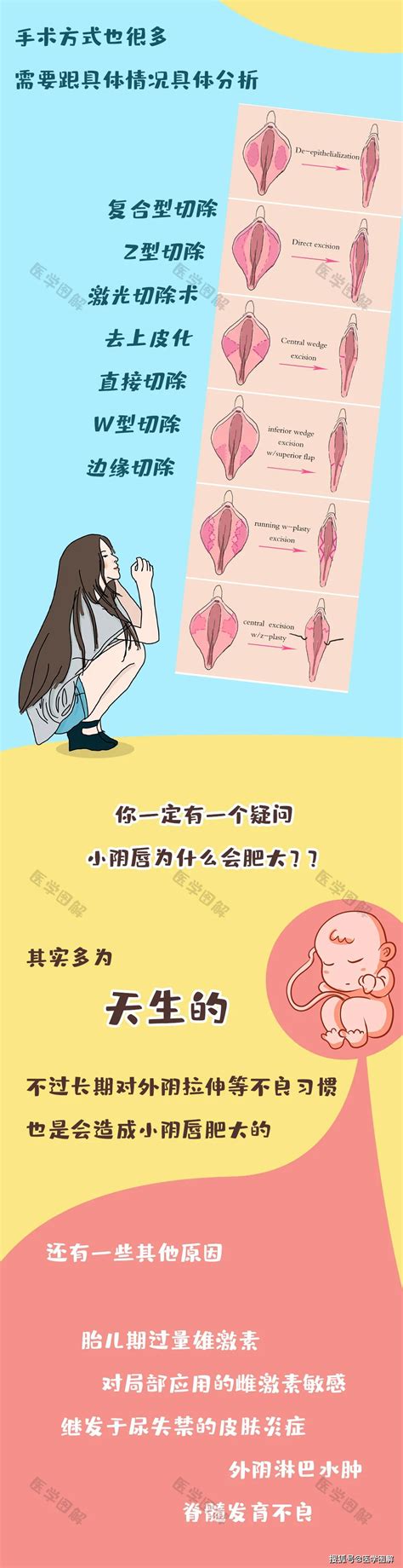 女人形|原来女性私处还有这么多型？这种形状一定要当心！丨医学图解